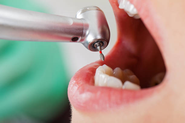 Best Emergency Treatment for Dental Infections or Abscesses in Granville, OH